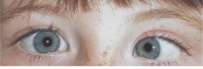 Left inwards eye turn (convergent squint)