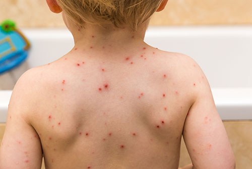 Child with chickenpox